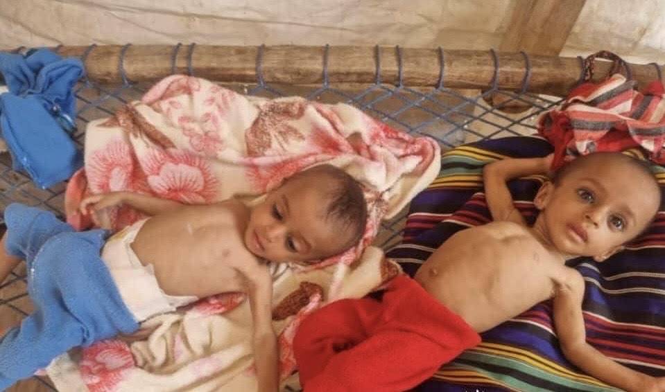الجوع ينهش أجساد الأطفال اليمنيين بعد توقف المنظمات الإنسانية (فيسبوك)