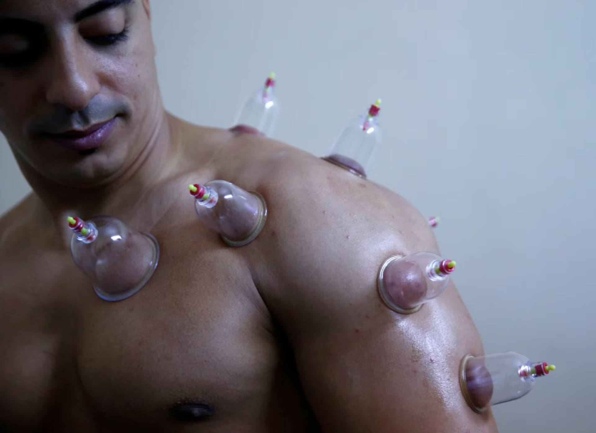 يرى الخبراء أن الحجامة قد تكون مفيدة عند استخدامها إلى جانب الطب الحديث وليست بديلاً له (رويترز)