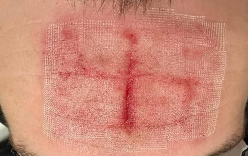 Ukrayna'da 30'dan fazla klinik savaş yaralarını iyileştirmek için yeni lazer teknikleri üzerinde çalışıyor (Telegraph)