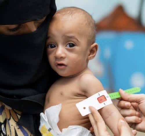 Ölümcül hastalıkların yanı sıra, milyonlarca Yemenli çocuk yetersiz beslenmeden mustarip (Yerel medya)