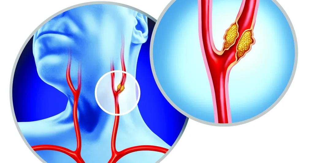 حلول فعّالة لعلاج انسداد شرايين العنق: كيف تقلل من مخاطر الجلطة الدماغية!