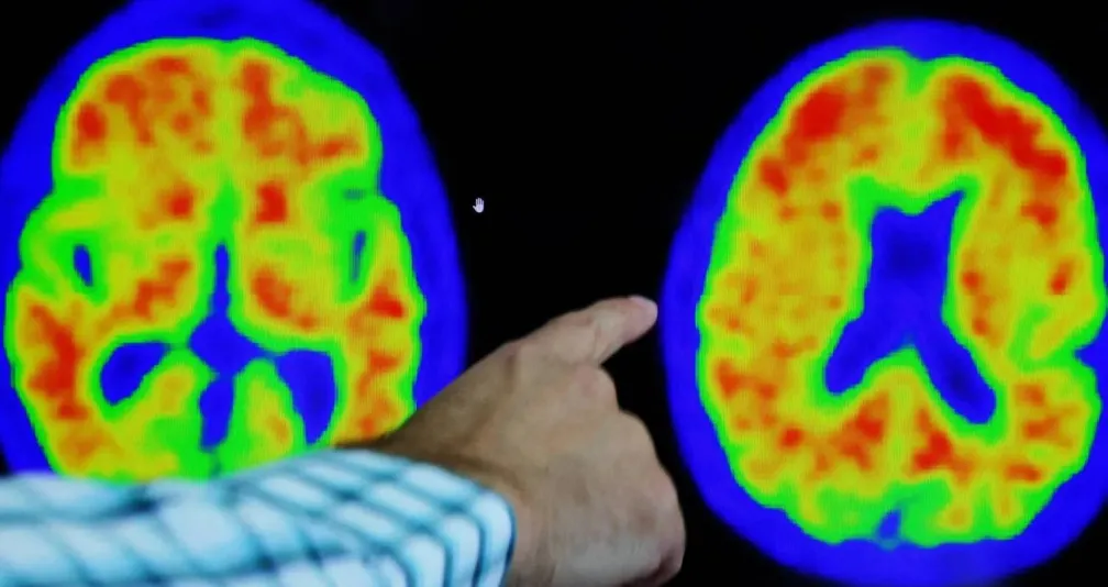 من «الفياغرا» إلى لقاحات مفاجئة: 5 أدوية يمكن أن تحارب ألزهايمر!