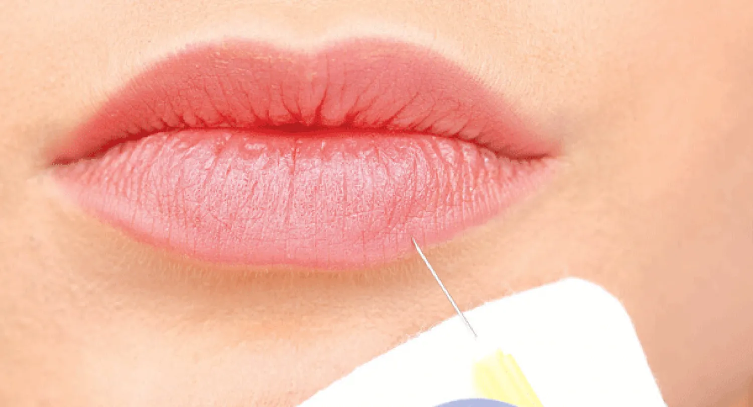 «حقن التعبئة» لتجميل الوجه.. نتائجها ومضاعفاتها