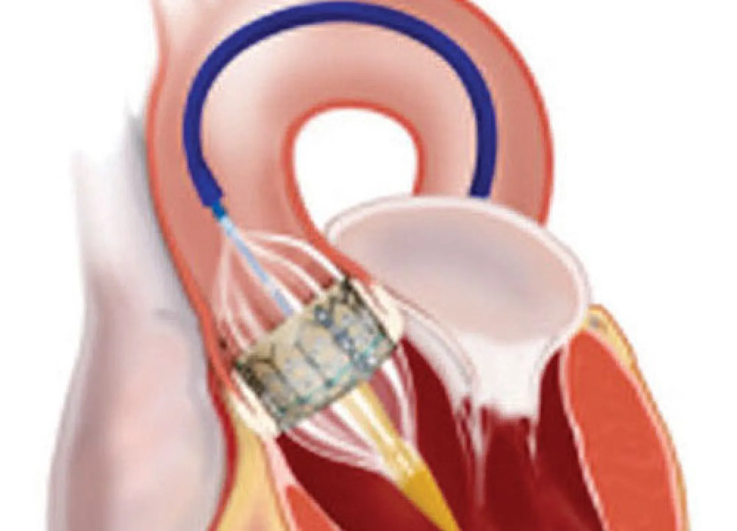مع تقدم الناس في العمر يترسب الكالسيوم على جدار الصمام الأورطي مما يؤدي إلى تصلبه وهي حالة تسمى طبيا بضيق الصمام الأورطي aortic valve. ونتيجة لعدم قدرة الصمامات على الانفتاح والانغلاق بصورة طبيعية، فإن الدم لا يتدفق بسلاسة. ولا تظهر أي أعراض لهذه الحالة المرضية إلا بعد سنوات، لكن قد يكتشفها الطب...