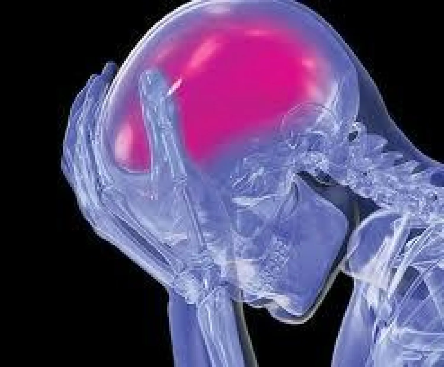 الباحثون: تزايد إصابات السكتة الدماغية عند من تقل أعمارهم عن 65 سنة