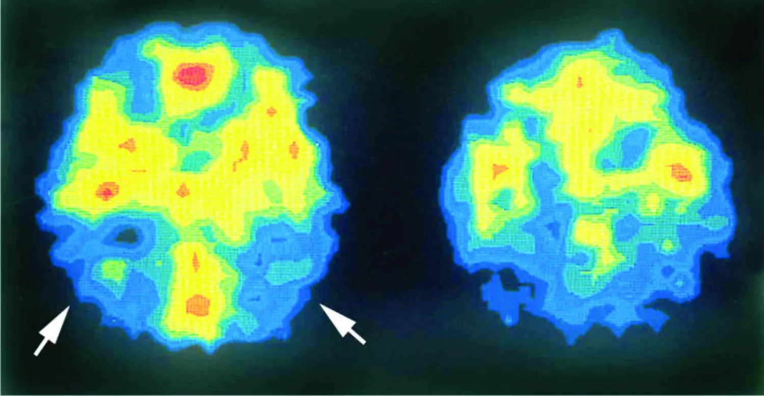 العلماء: اكتشاف المادة الكيميائية لعلاج مرض ألزهايمر نقطة تحول في تاريخ الطب