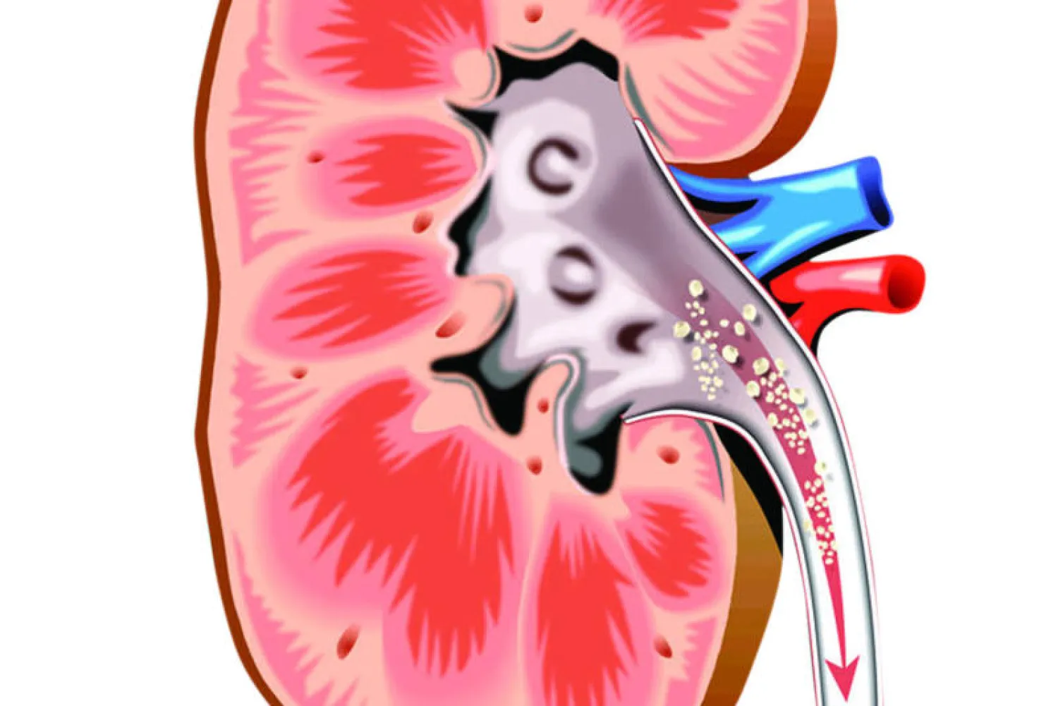 نصائح للوقاية من الحصى الكلوية