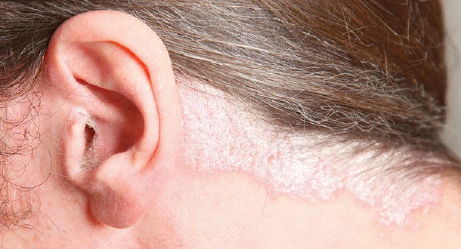 حقائق مهمة حول مرض الصدفية