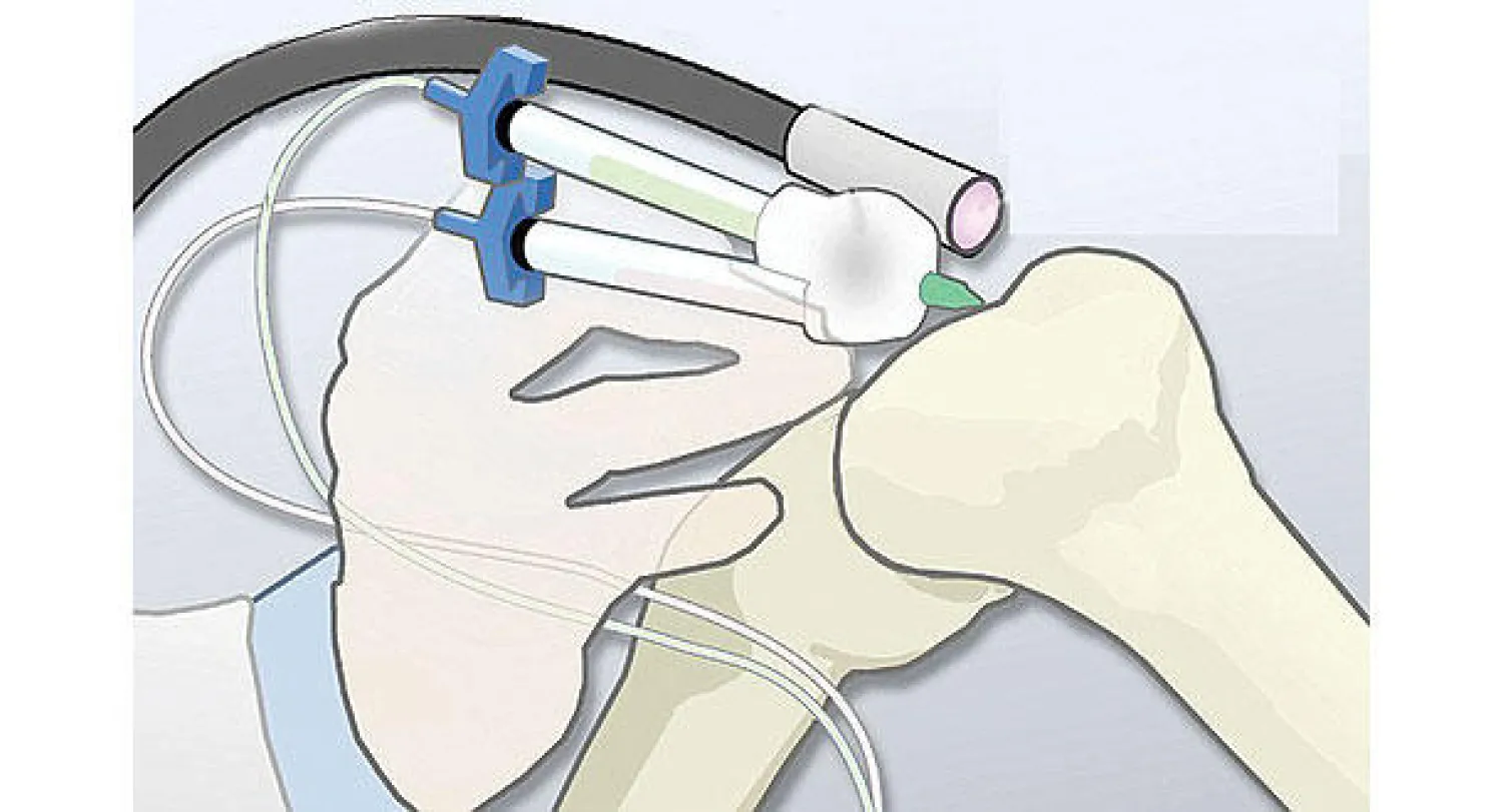 «قلم بيولوجي» لإدخال خلايا بشرية إلى مواقع الجسم المتضررة