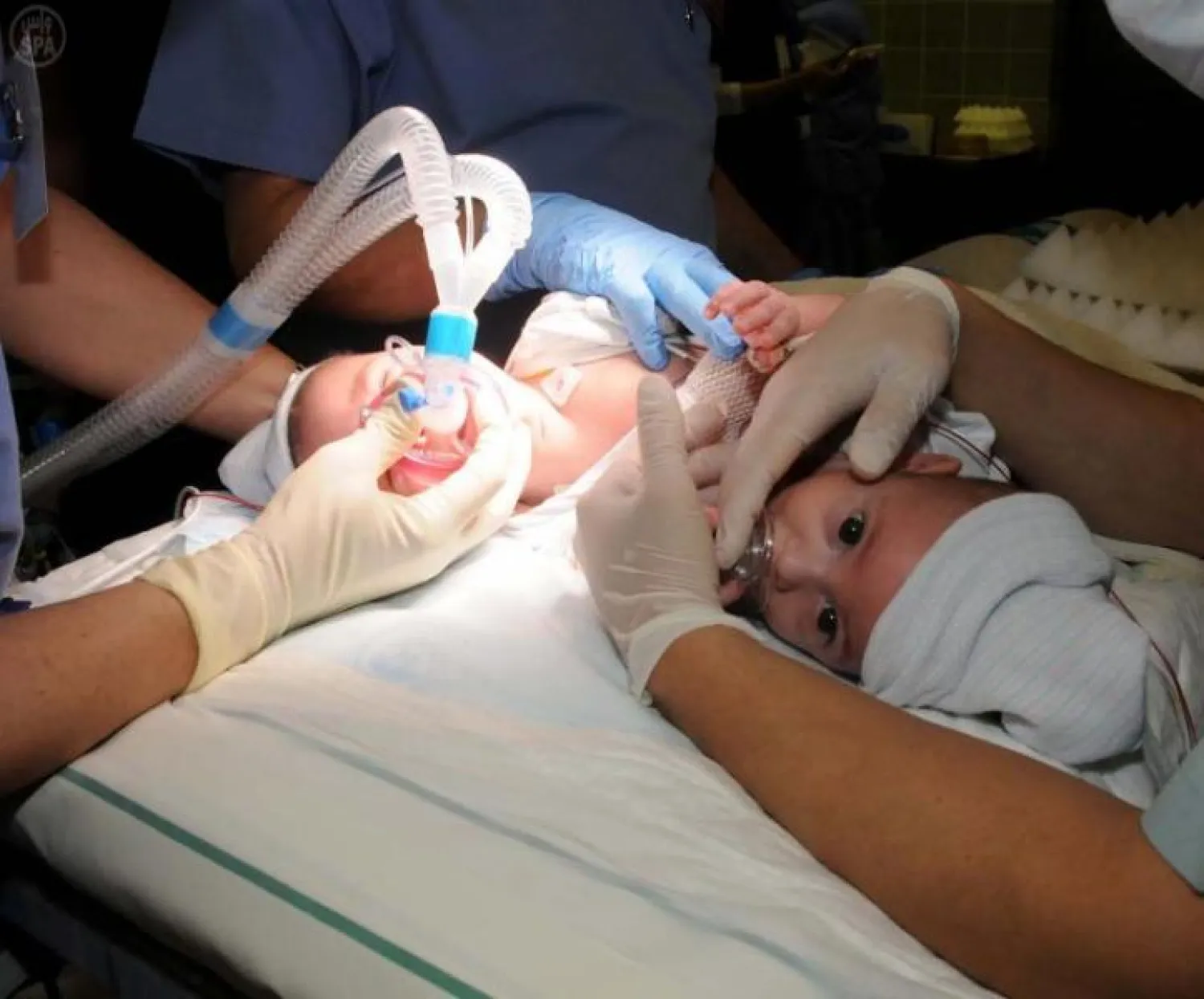 فصل ناجح للتوأم السيامي العراقي كريس وكرستيان في السعودية