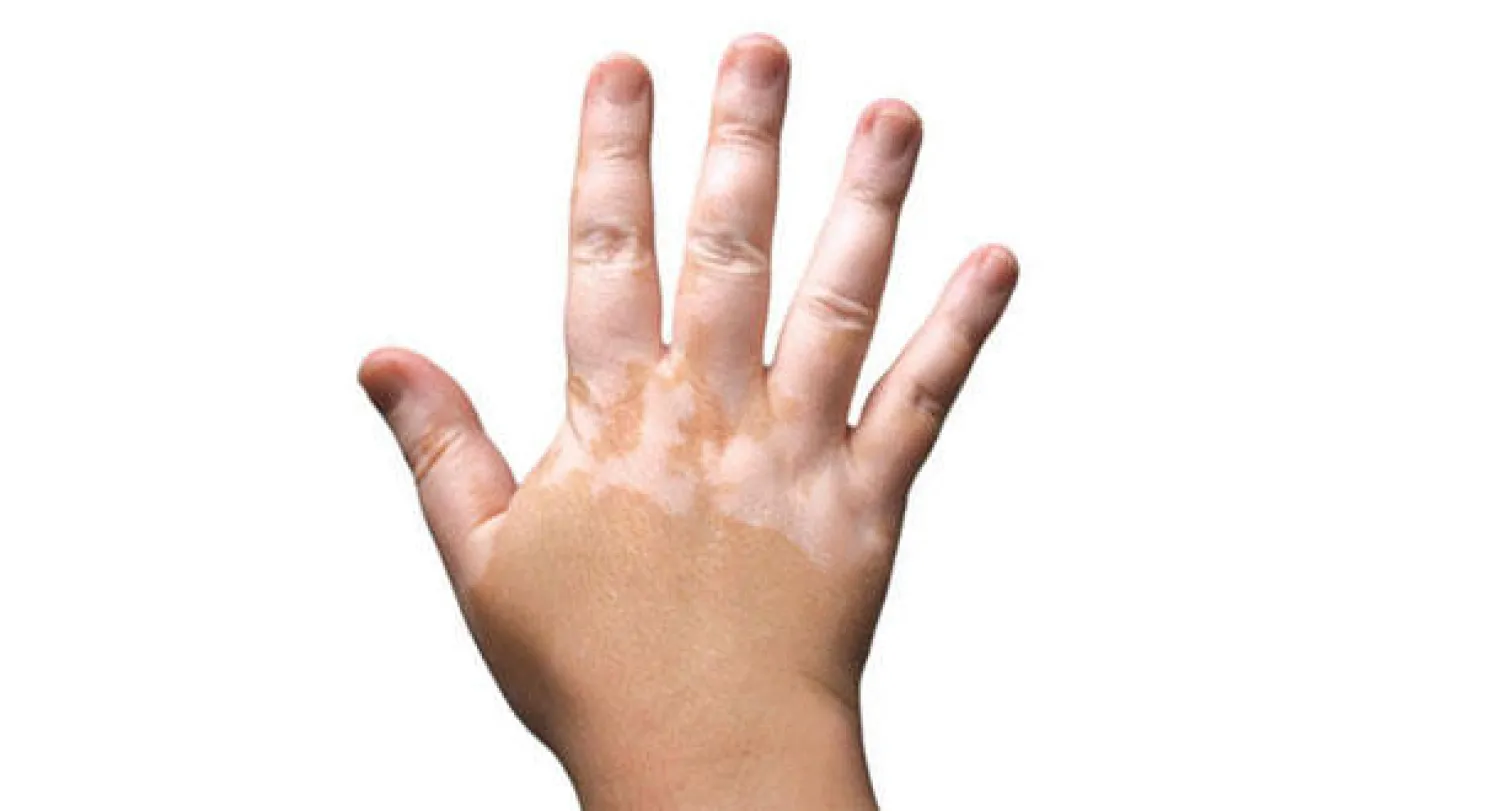 نسبة المصابين بالبهاق في السعودية تبلغ ثلاثة في المائة