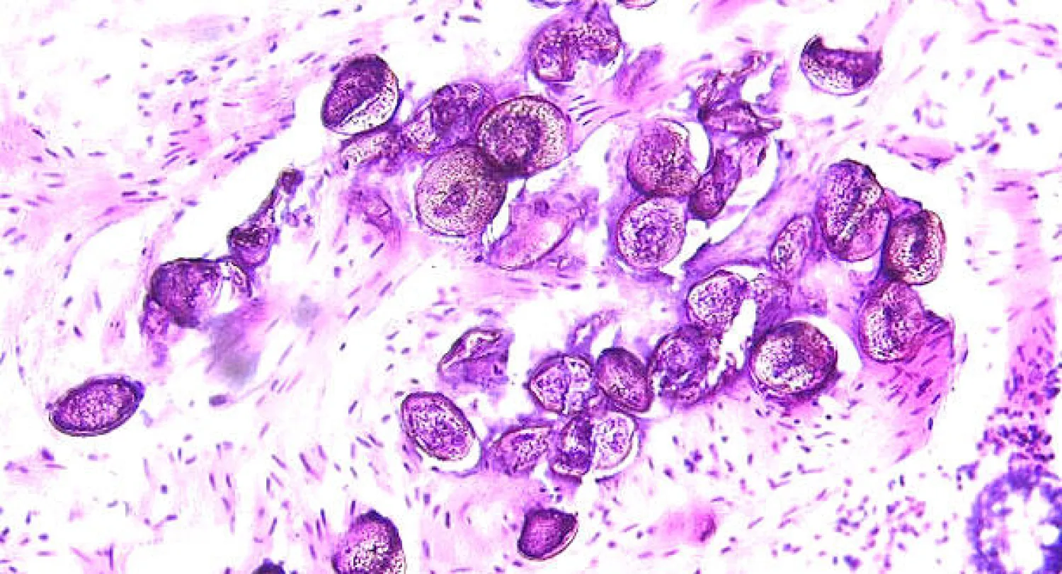 اكتشاف بويضة لطفيل البلهارسيا في سوريا عمرها 6200 سنة