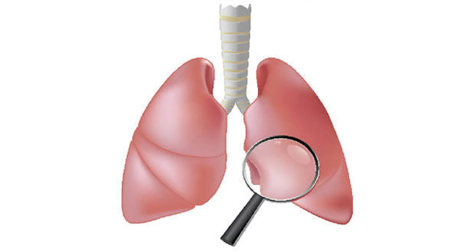 مرض السل.. وضرورة معالجته الصحيحة