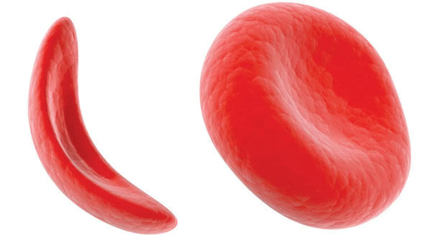 أمل جديد لمرضى الخلايا المنجلية