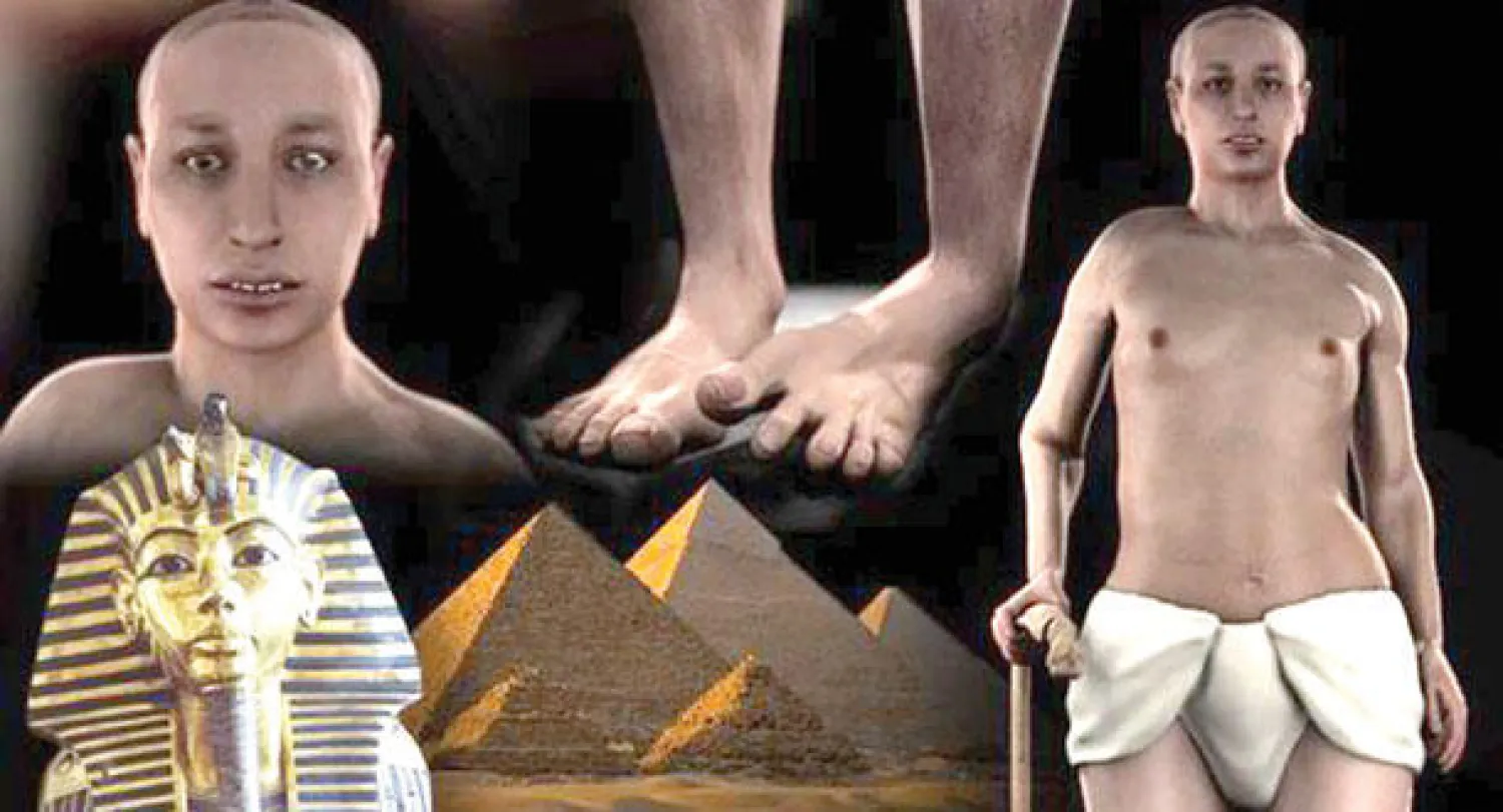 صور الأشعة ثلاثية الأبعاد لتوت عنخ آمون تظهر إصابته بـ «القدم المشوهة الحنفاء» وهو اعوجاج للقدم نحو الداخل