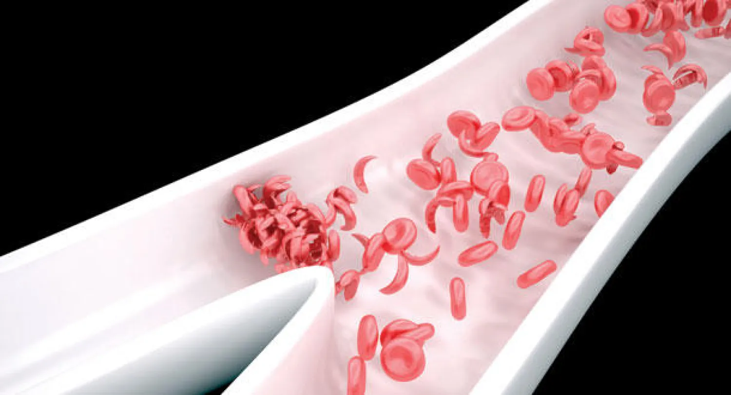 نتائج واعدة لعلاج دوائي آمن لمرضى {أنيميا} الخلايا المنجلية