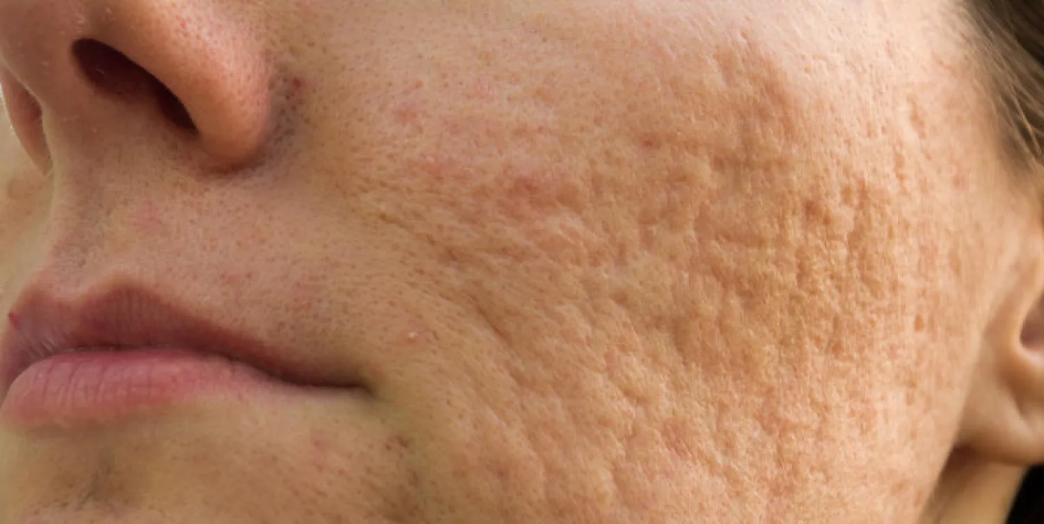 أميركا تكشف أحدث علاج لندوب حب الشباب