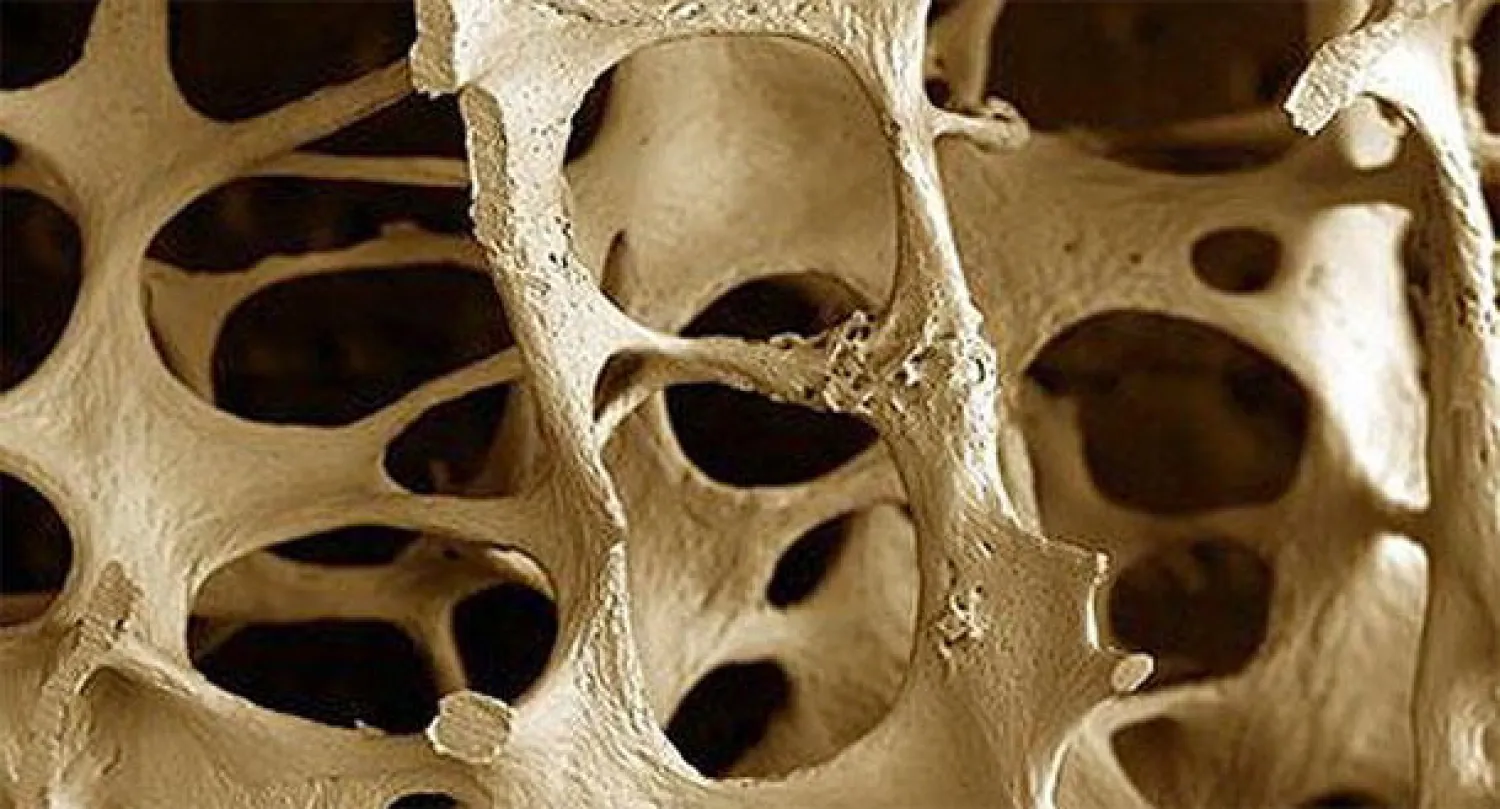 هشاشة العظام تزيد من مخاطر الإصابة بصمم مفاجئ