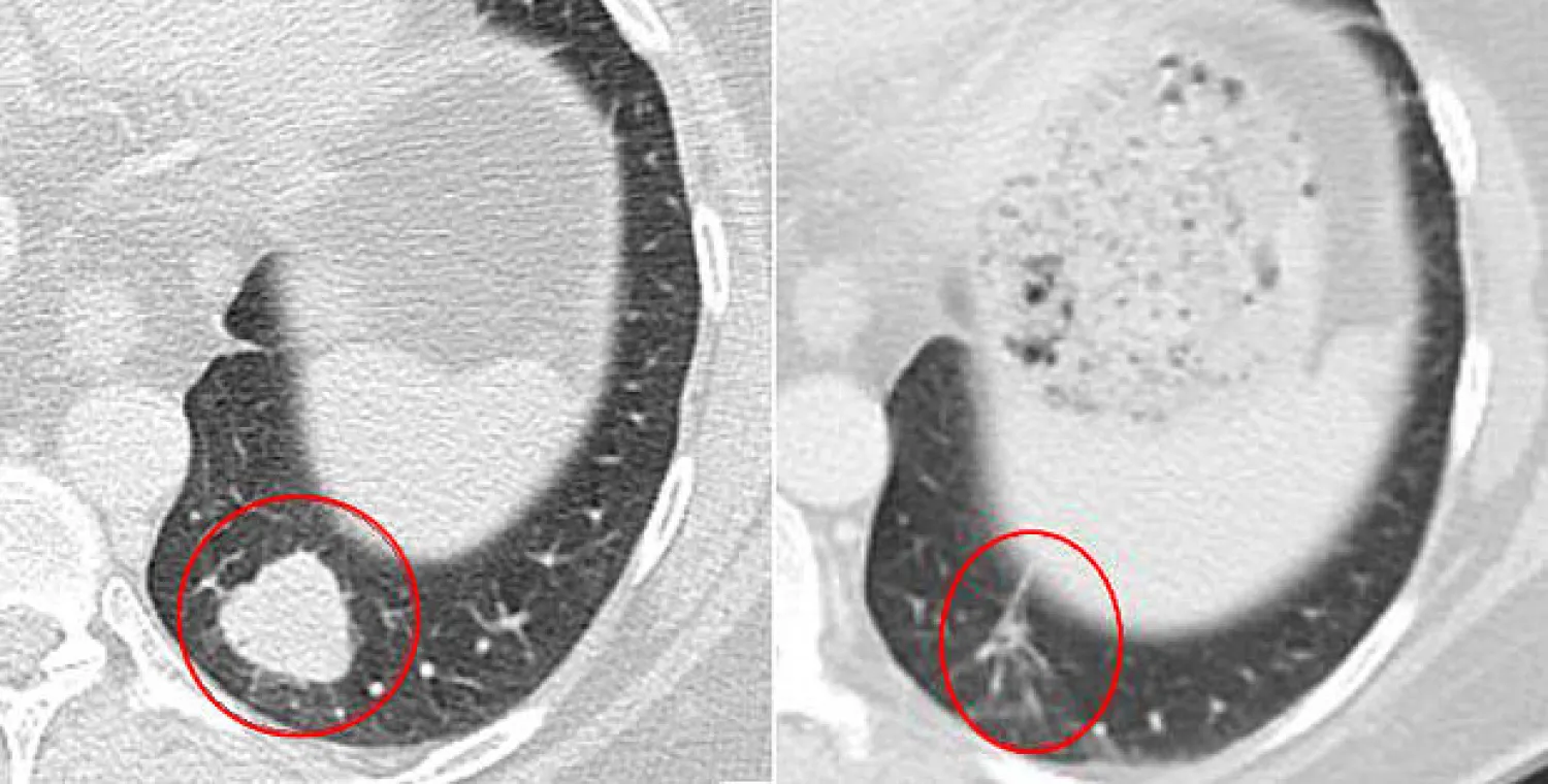 نقطة نور تضيء النفق لمرضى السرطان