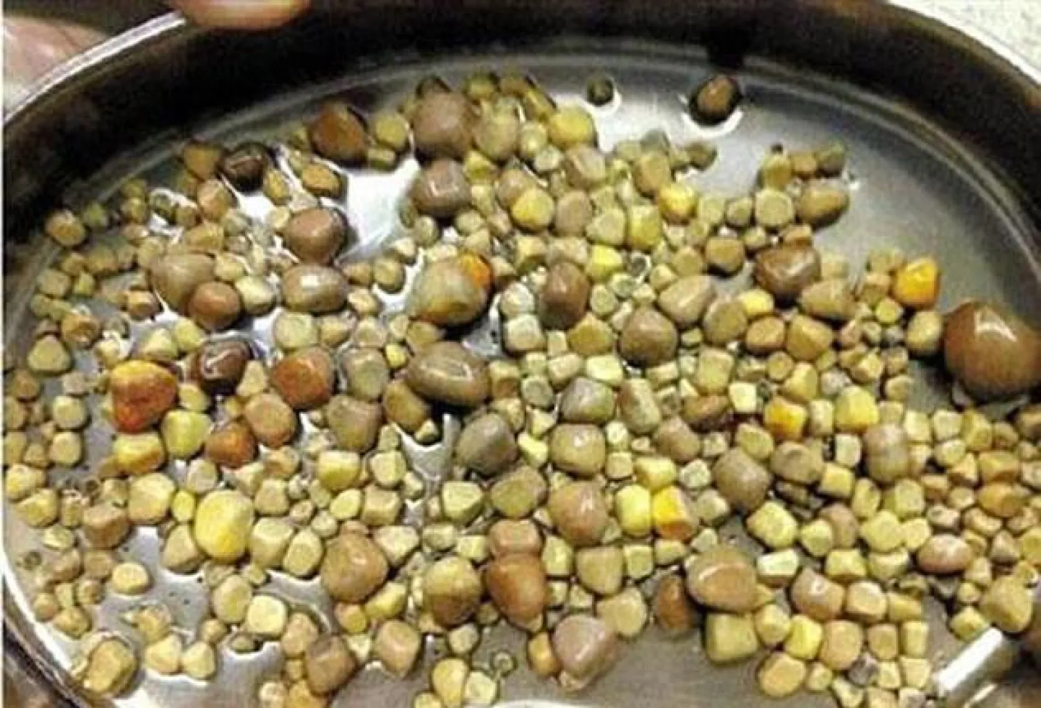 420 حصاة في كُلية «عاشق الجبن» بالصين