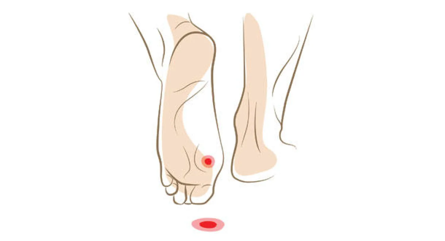 يوليو.. شهر التوعية الصحية للأميركيين بمخاطر الثآليل