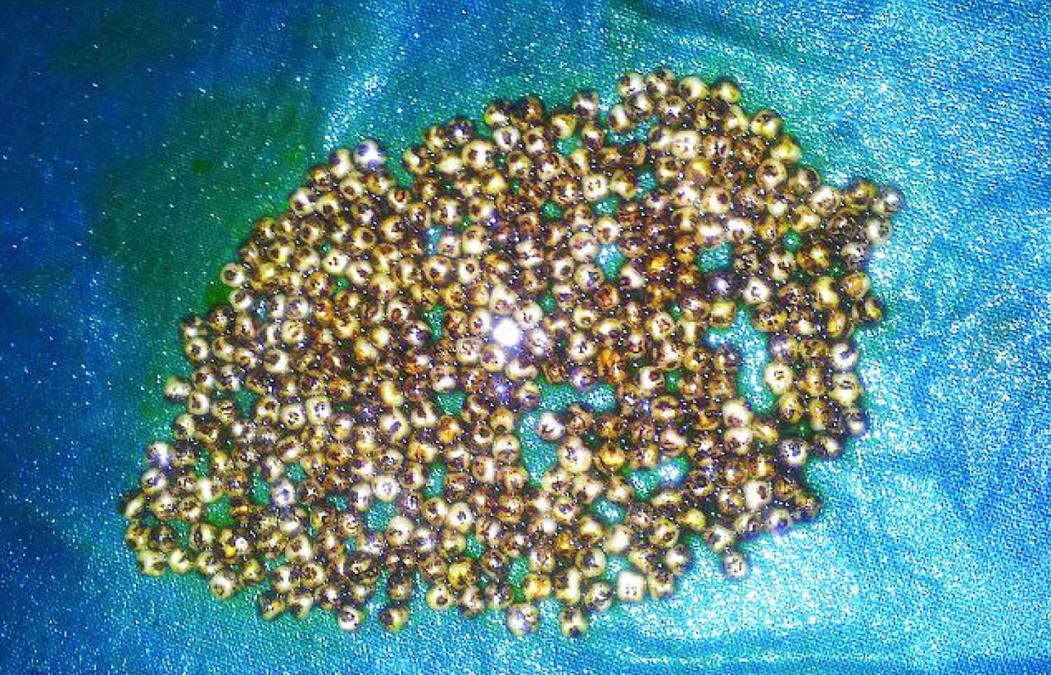 استخراج 360 حصاة من مرارة سيدة هندية