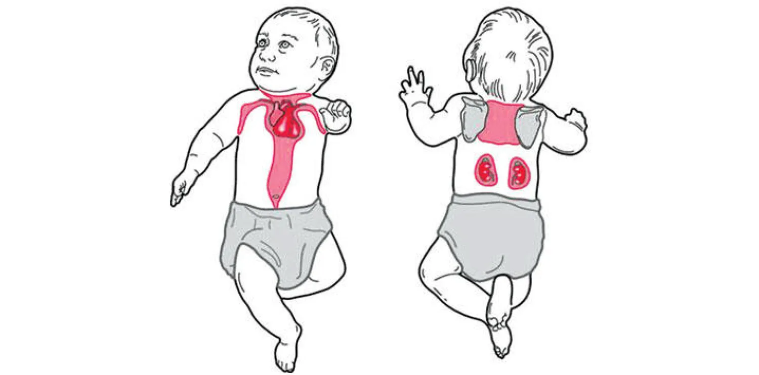 مناطق الدهون البنية لدى الأطفال