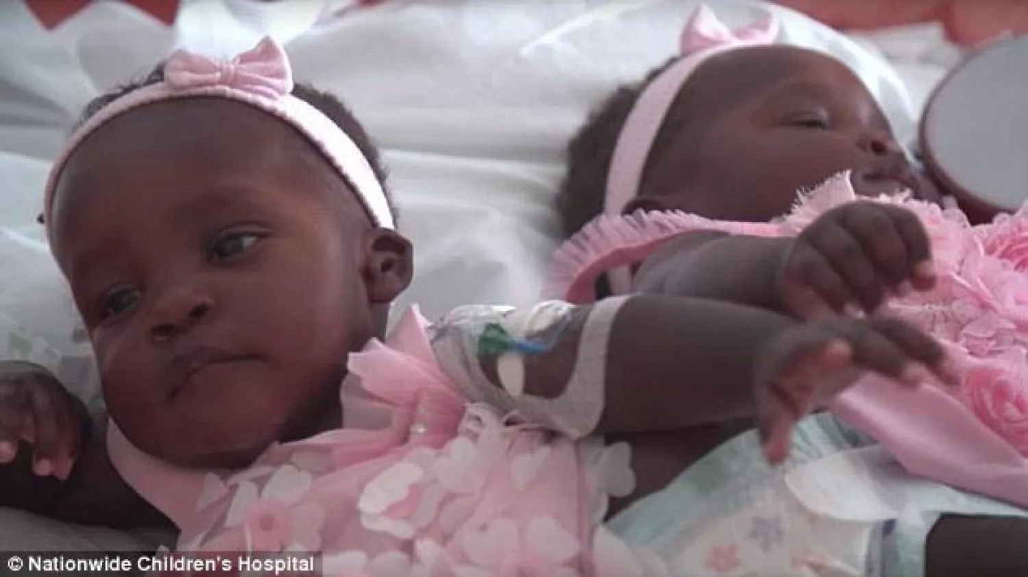 فصل توأمين أوغنديتين بعد 16 ساعة تحت التخدير