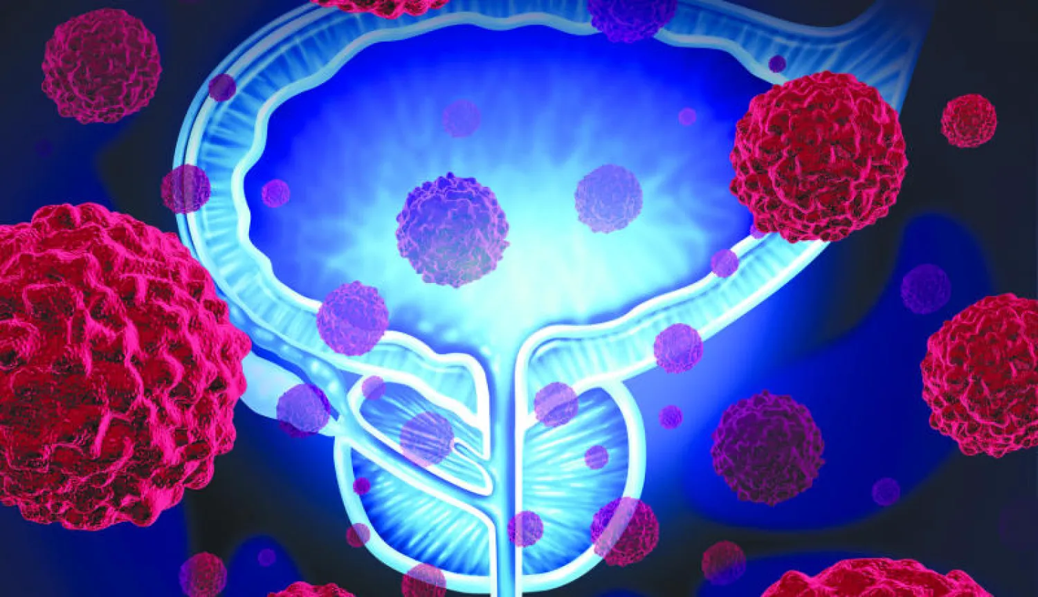 اكتشاف جين «انتحاري» يقتل خلايا سرطان البروستاتا