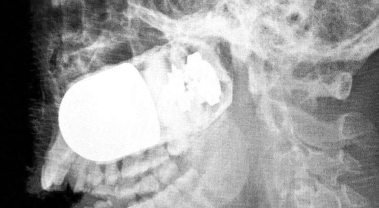 صورة الأشعة  التي تظهر وجود القنبلة (إ.ب.أ)