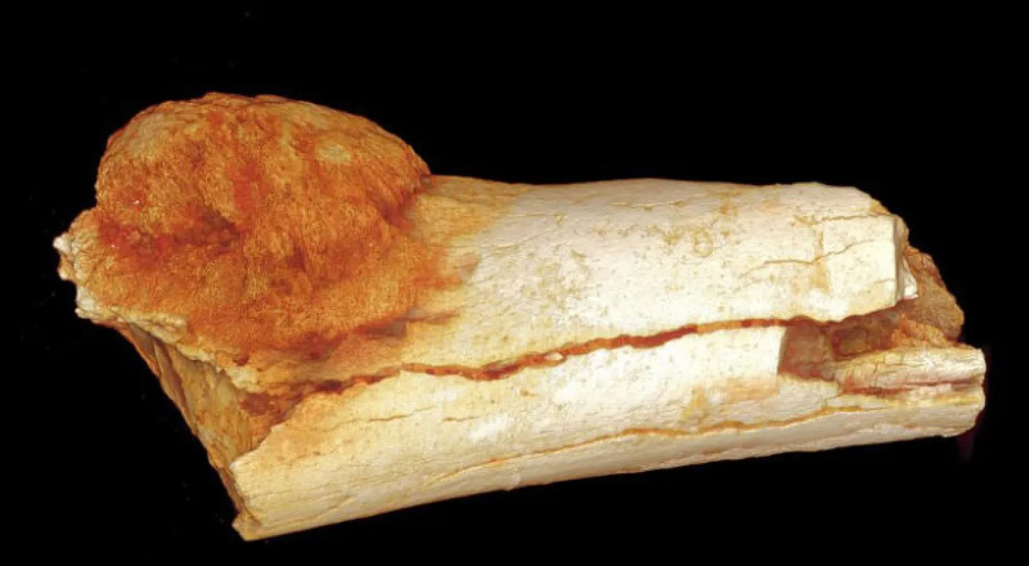 علماء يكتشفون أقدم إصابة بالسرطان تعود إلى 1.7 مليون سنة