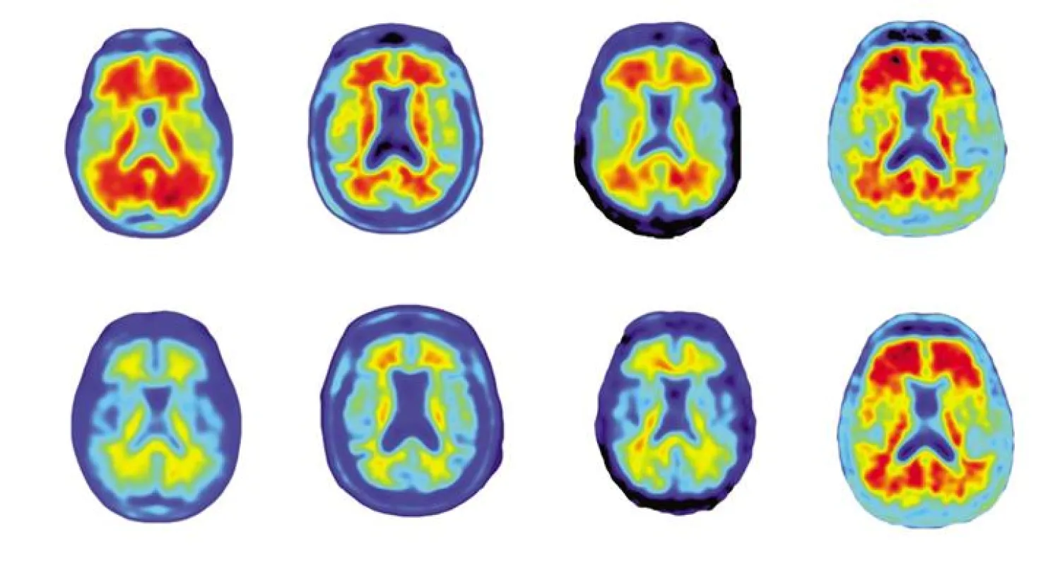 نتائج أولية ناجحة لعلاج تجريبي جديد ضد ألزهايمر