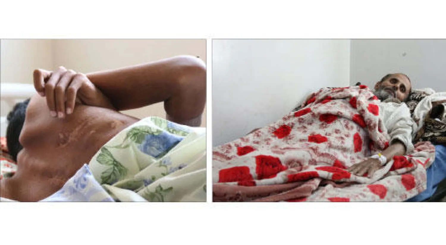 عبد القادر محمد من ضحايا القصف الانقلابي في البيضاء  («الشرق الأوسط») - آثار شظية أطلقتها الميليشيات على جسد شاب يمني في تعز