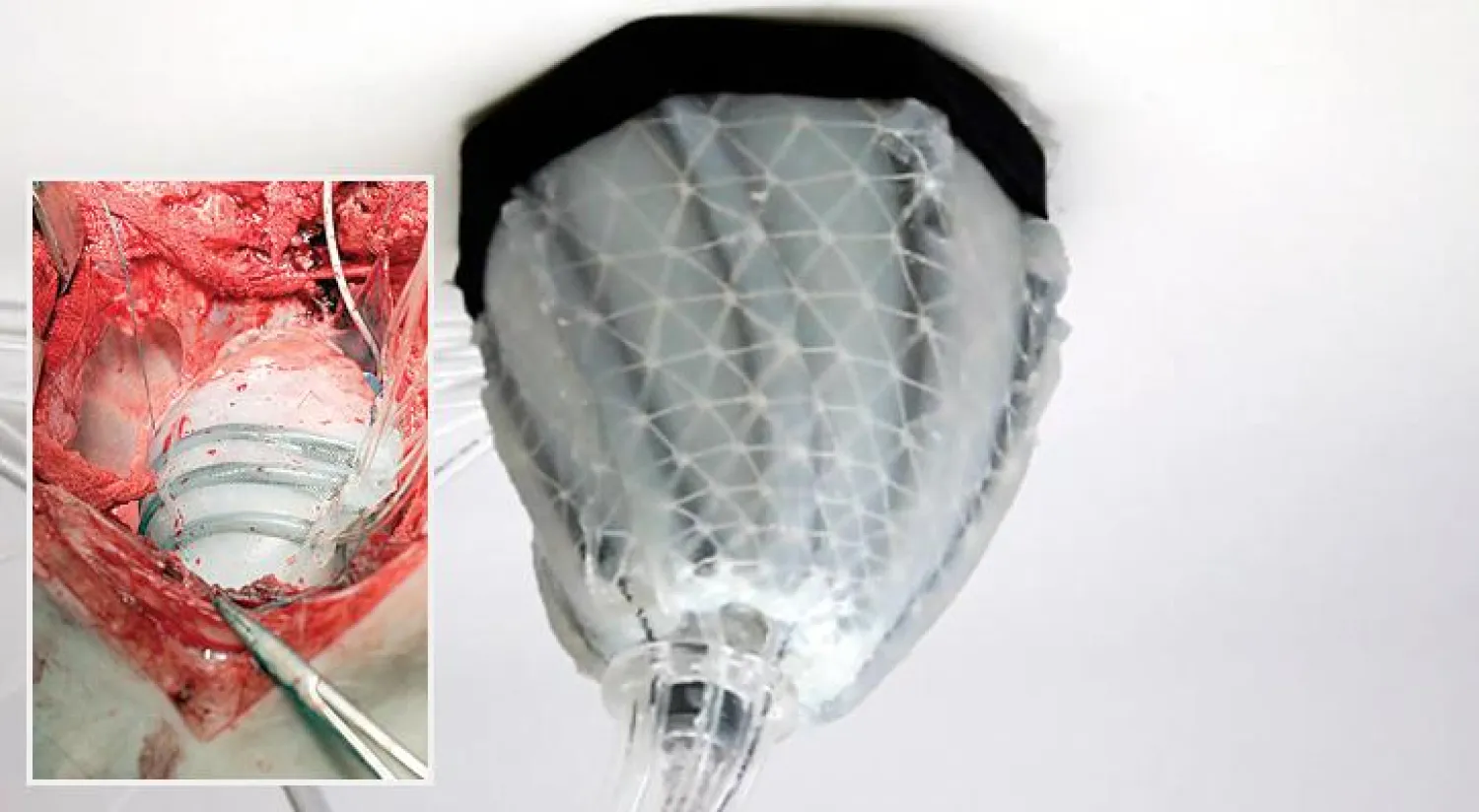 «كُمّ روبوتي»... لمرضى عجز القلب