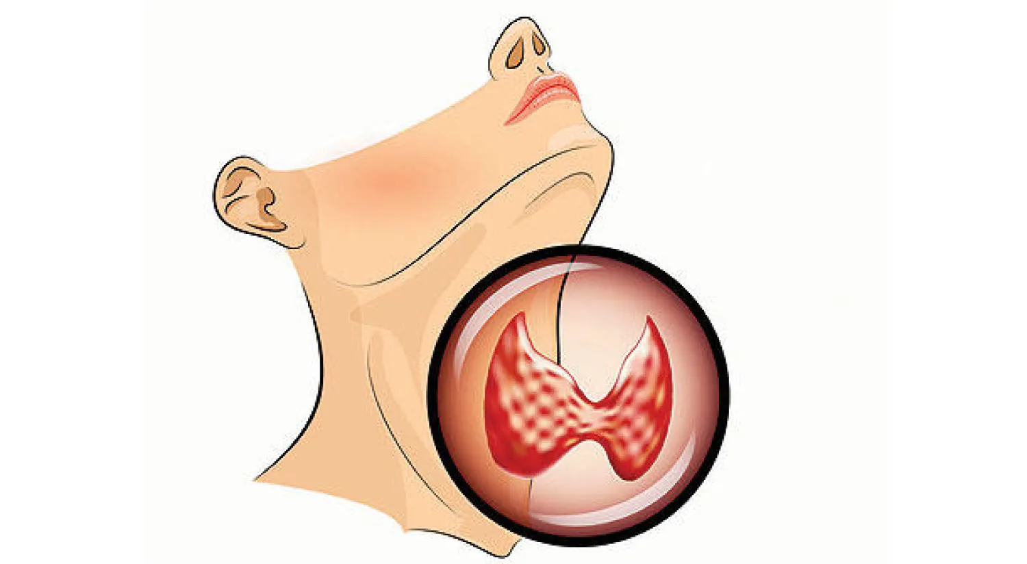 نظرة على اضطرابات الغدة الدرقية
