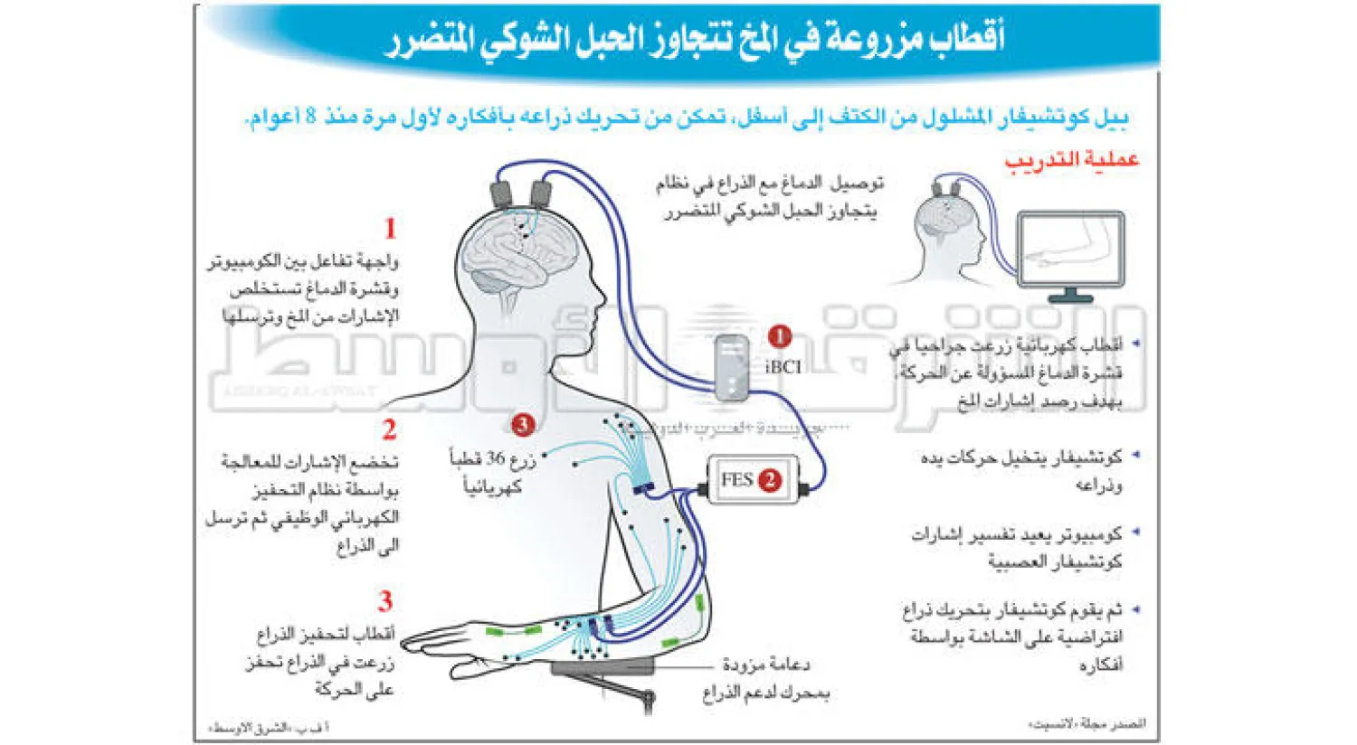 في اختراق علمي: «ذراع صناعية ـ عصبية» تسمح لمشلول بتناول طعامه