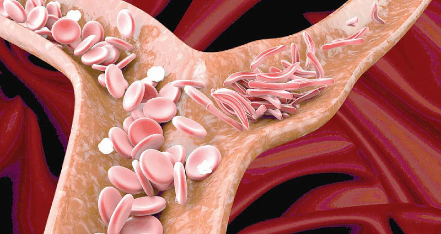 أنيميا كريات الدم صغيرة الحجم لدى الأطفال