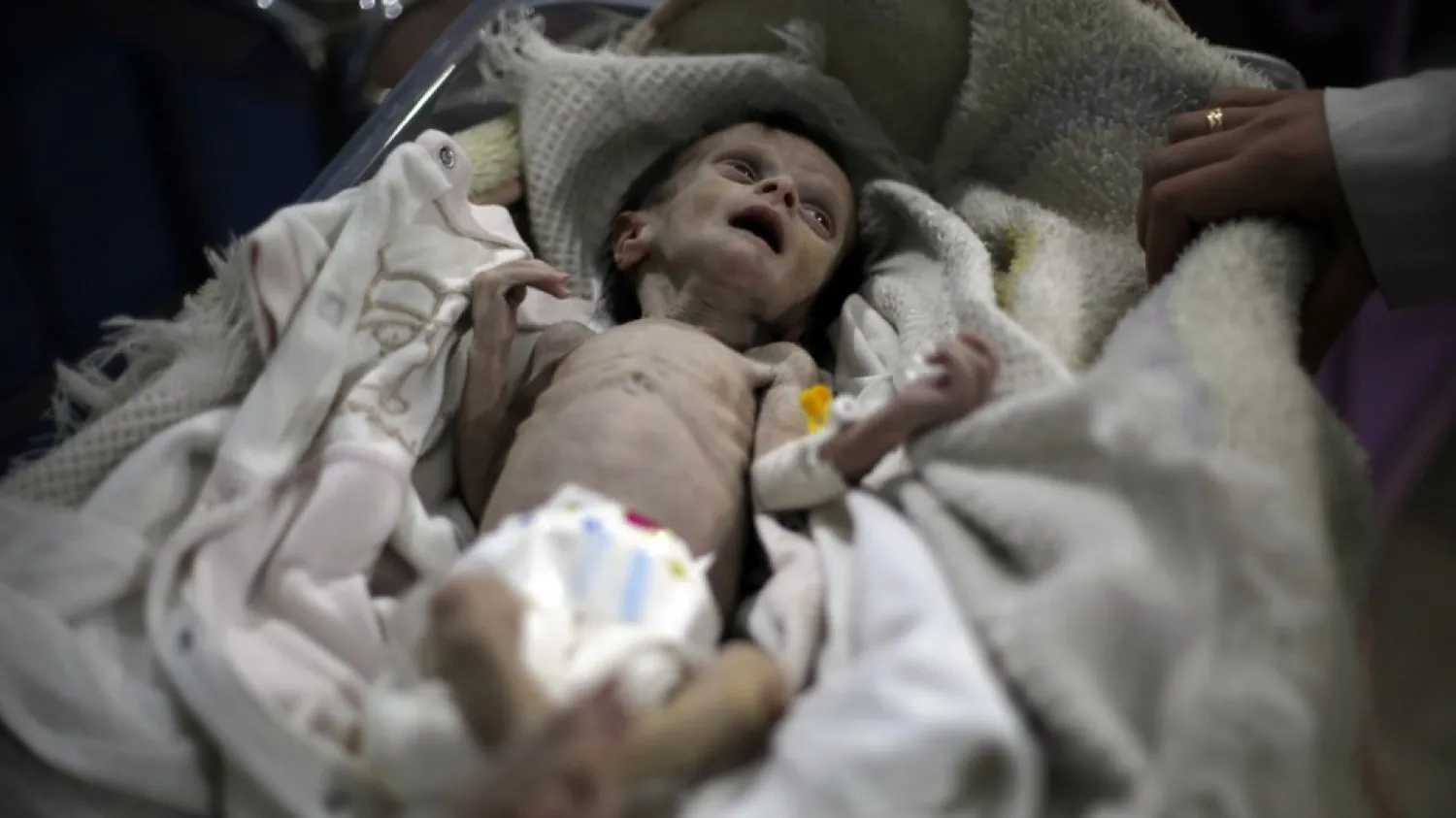 Syrian infant Sahar Dofdaa, suffering from severe malnutrition, is seen at a clinic in the rebel-controlled town of Hamouria, in the eastern Ghouta region on the outskirts of the capital Damascus, on Saturday. Photo: AFP