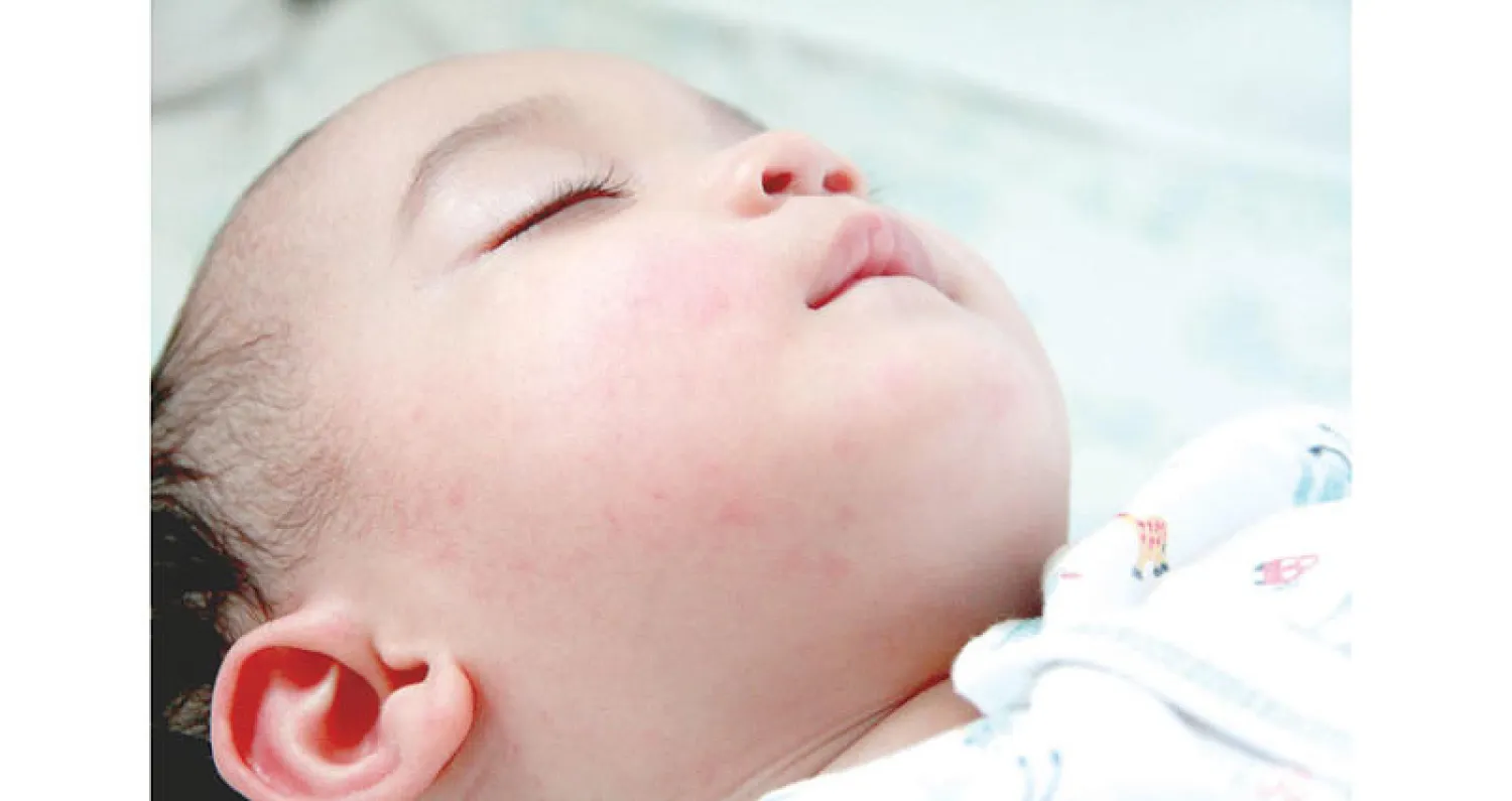 حمى الضنك... مخاوف الانتشار وسبل العلاج