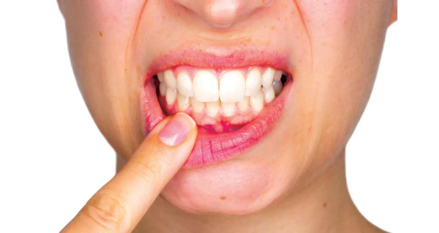 أمراض اللثة المزمنة... تداعيات صحية متعددة تتطلب الاهتمام