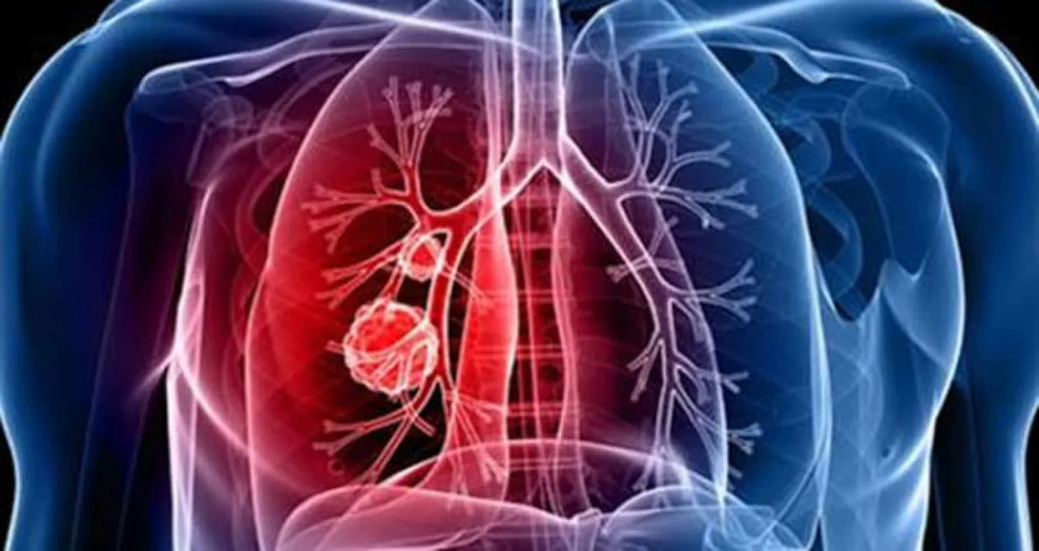 منظومة للذكاء الصناعي قادرة على اكتشاف الأورام السرطانية في الرئة