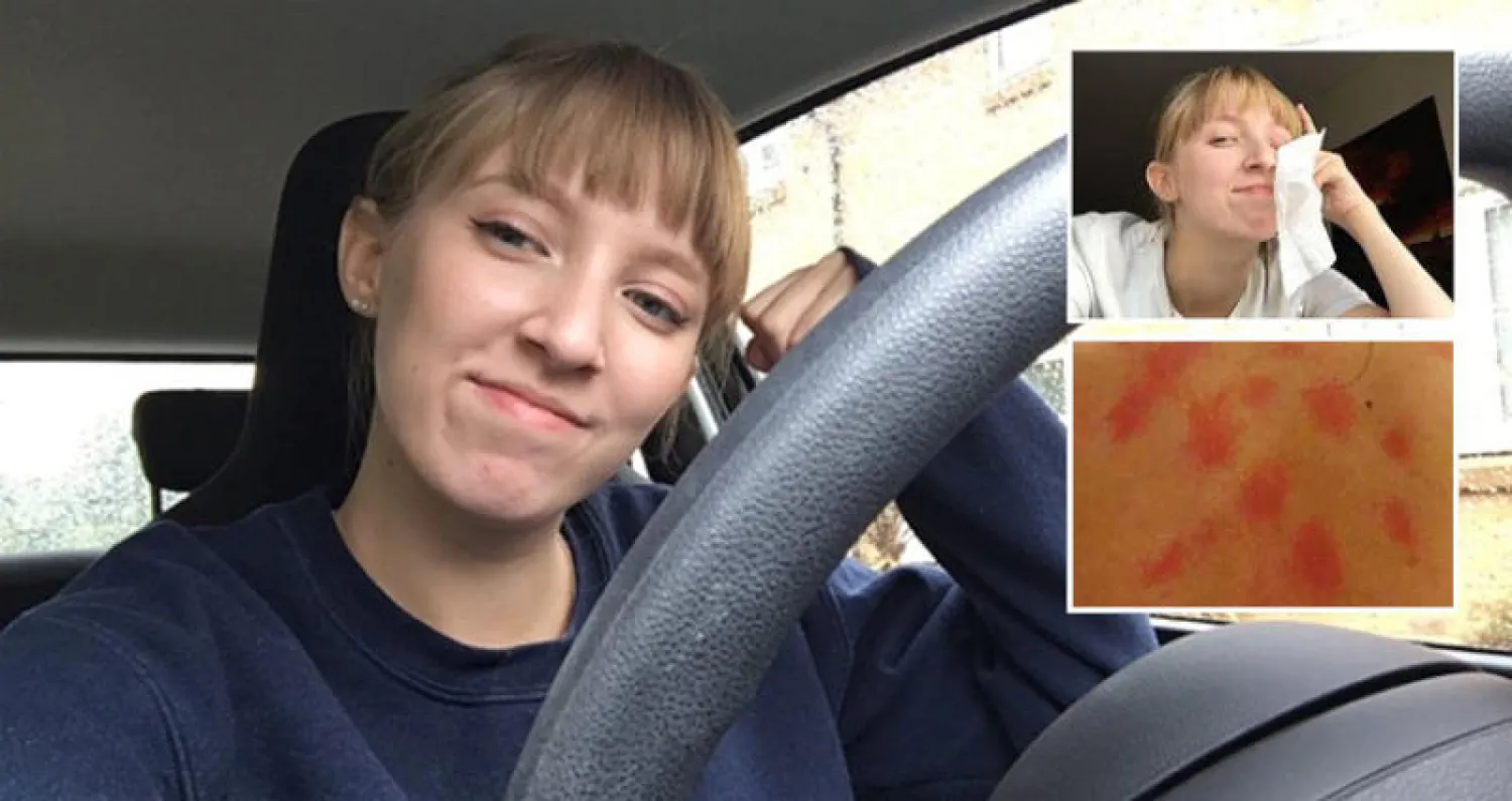 ليندسي كوبري تعاني من مرض حساسية المياه النادر