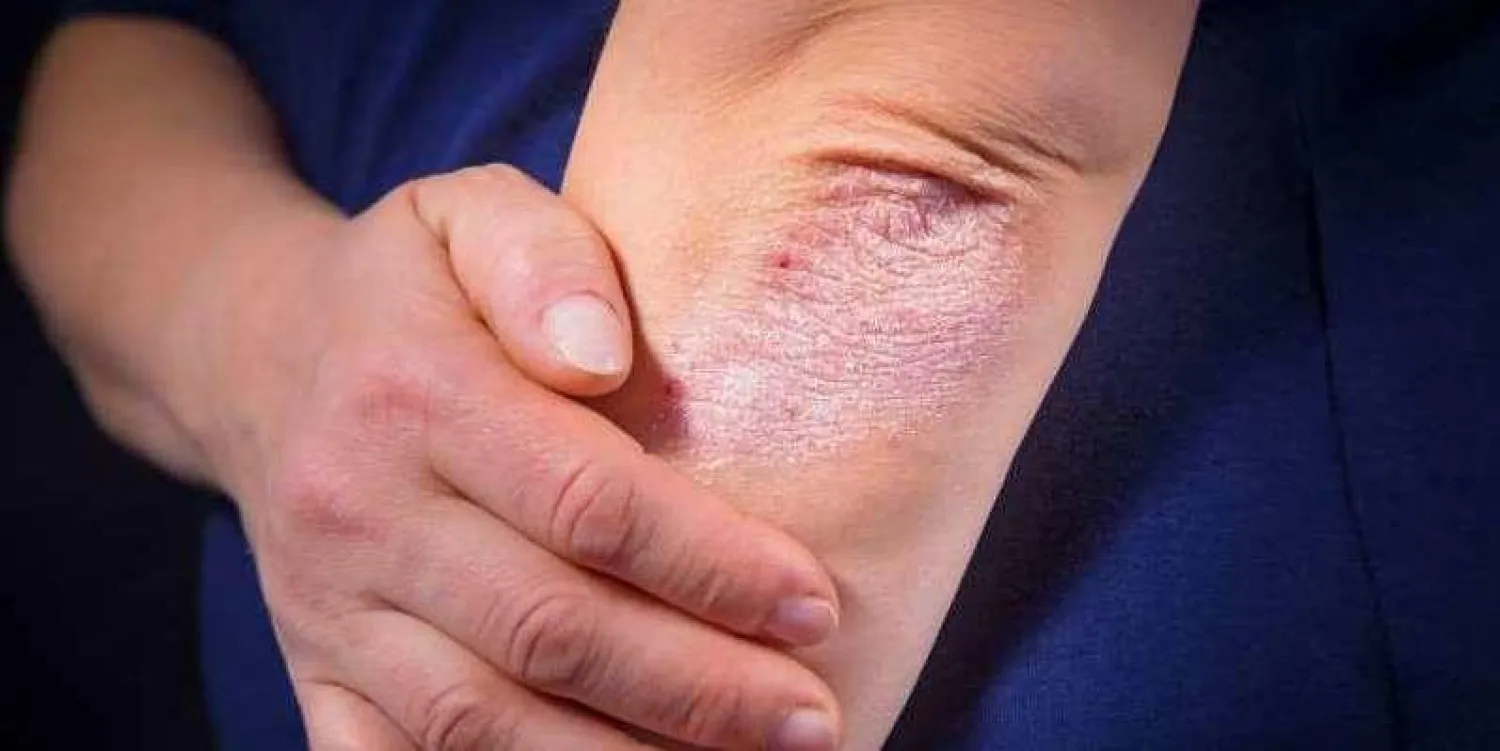 باحثون فحصوا بيانات 60 دراسة لأساليب الطب البديل والتكميلي لتخفيف أعراض الصدفية (غيتي)