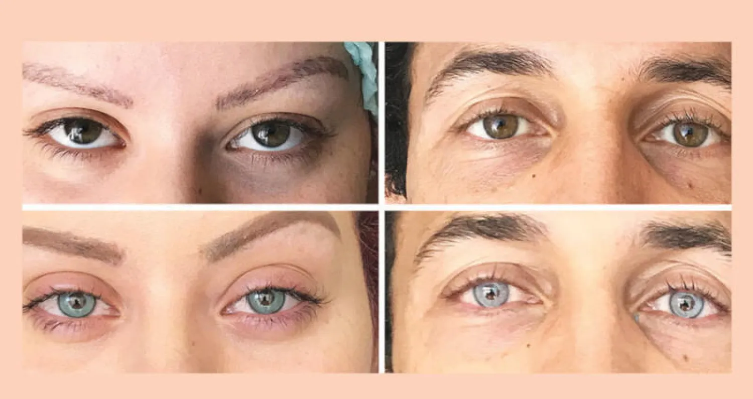 تغير لون العين بالليزر