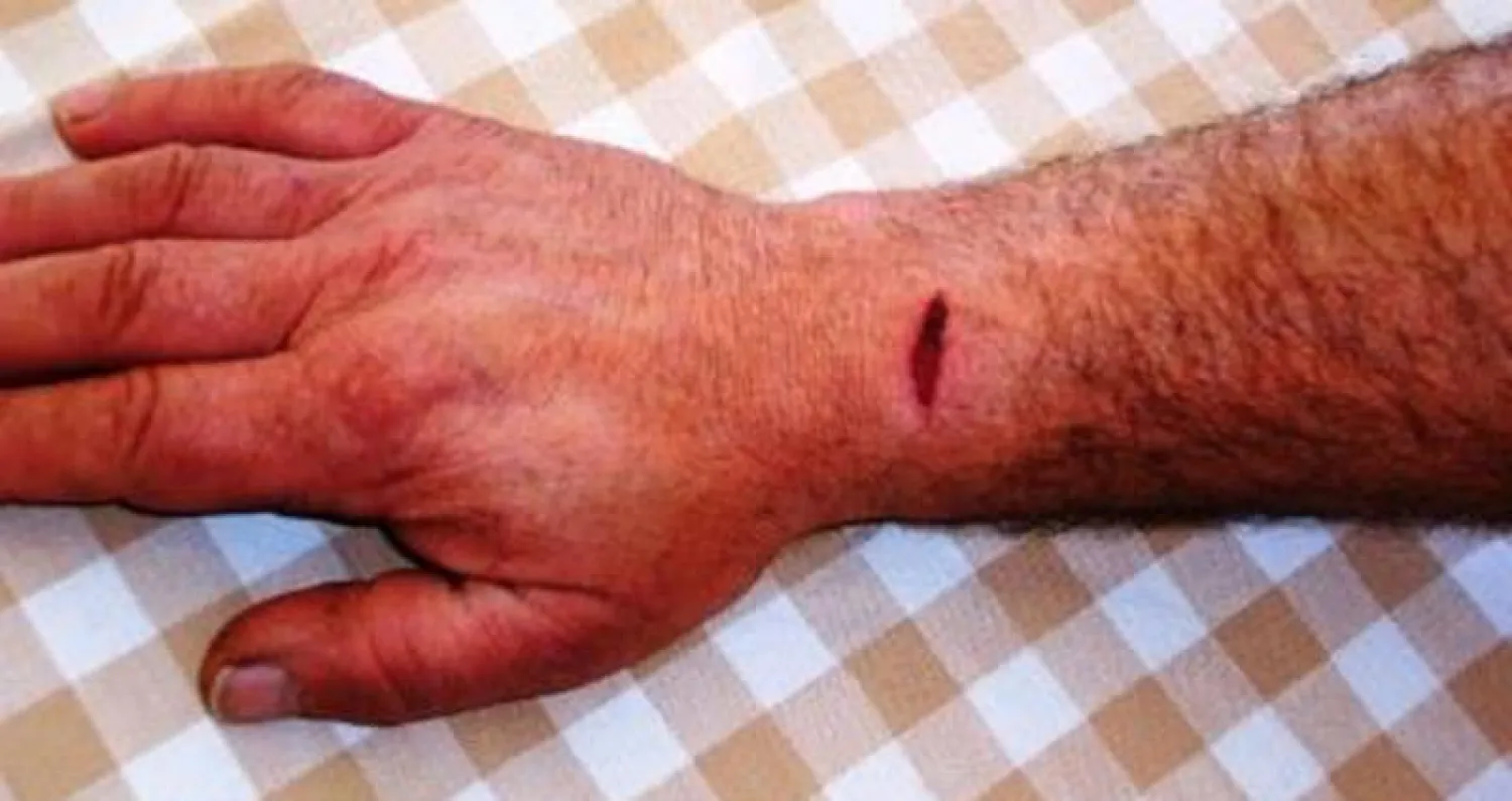 جهاز إلكتروني يراقب معدل اندمال الجروح