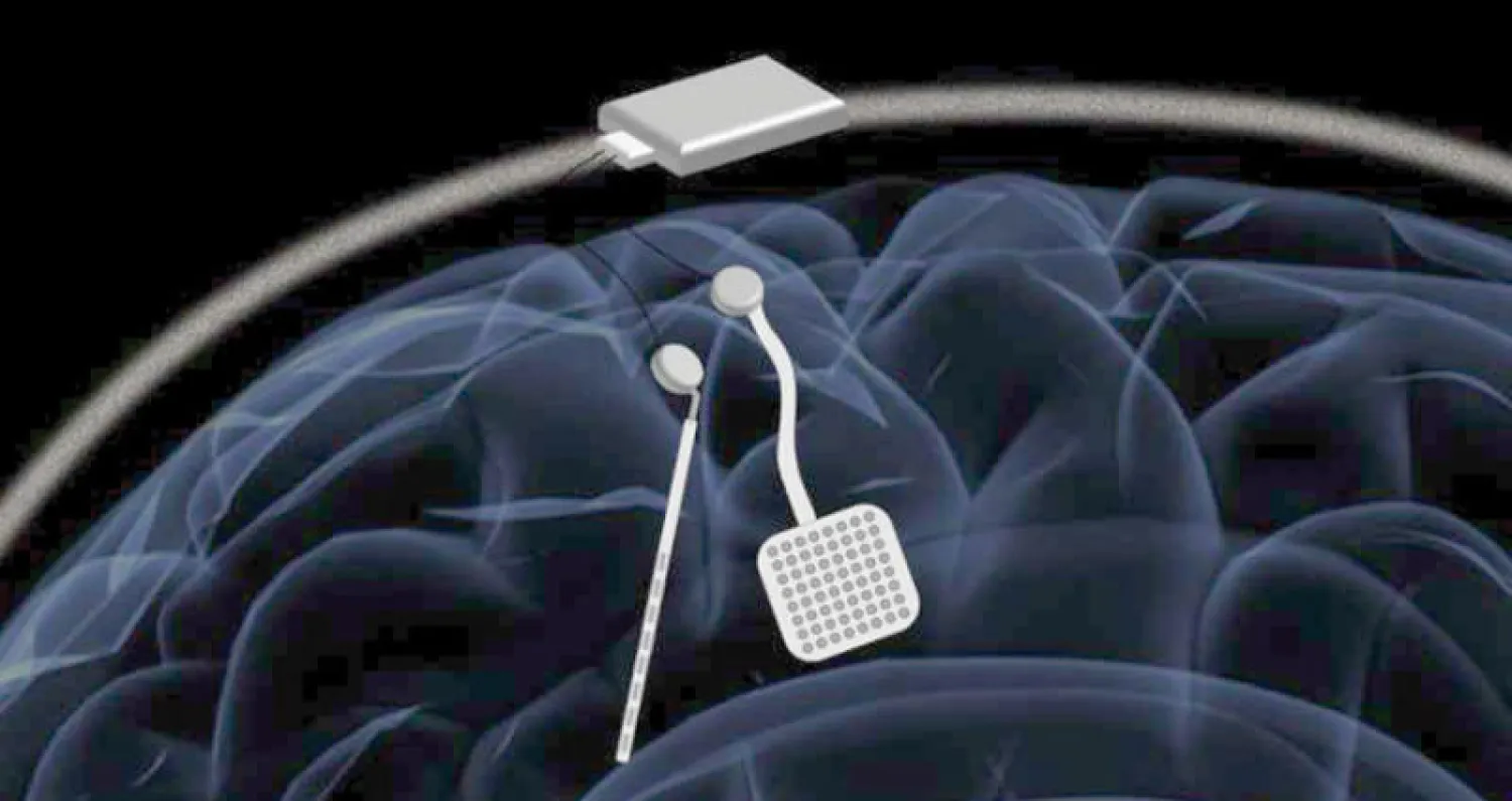 جهاز تحفيز عصبي جديد