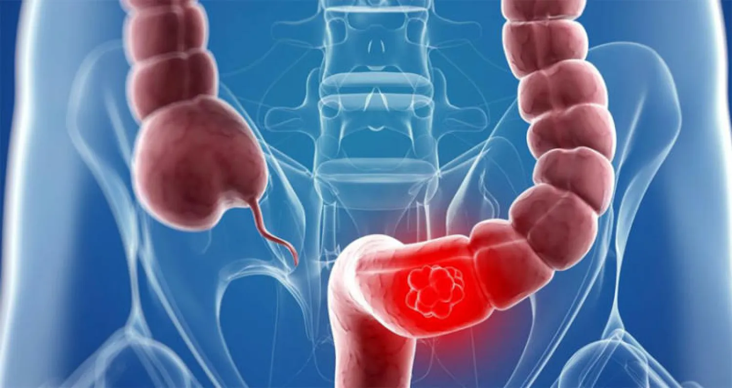فريق أميركي يطور مركباً لتوقيف انتشار سرطان القولون