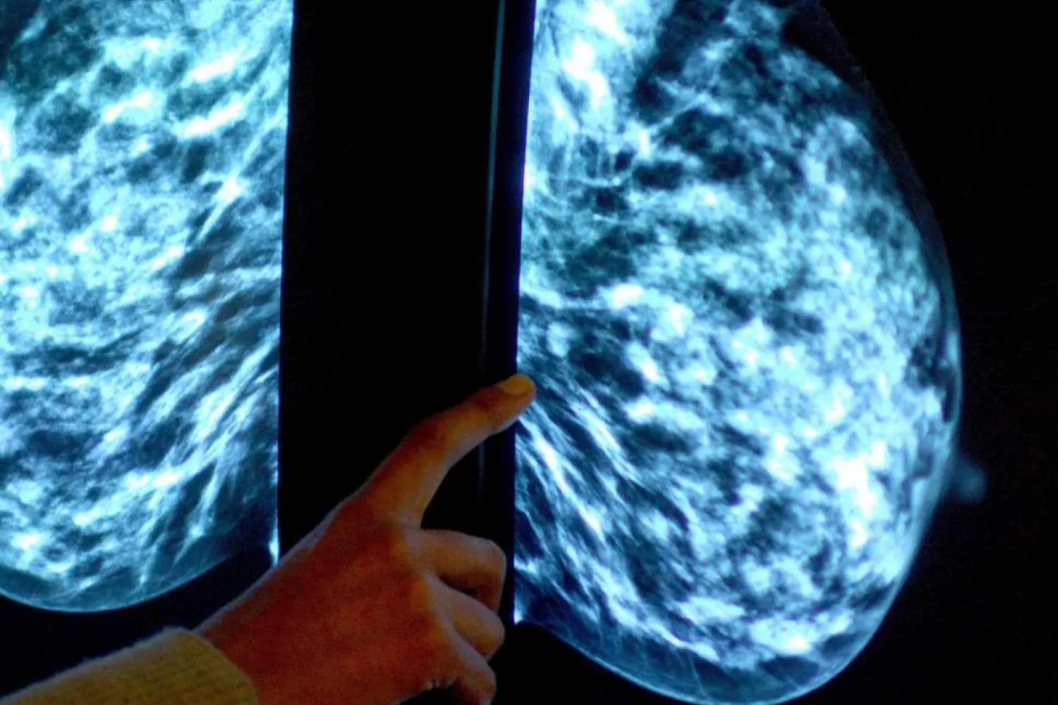 Bulgular, mamogram takibini ve tedaviyi, kanserin tekrarlama riski olduğu dönemlere uyarlamak için kullanılabilir. (PA)