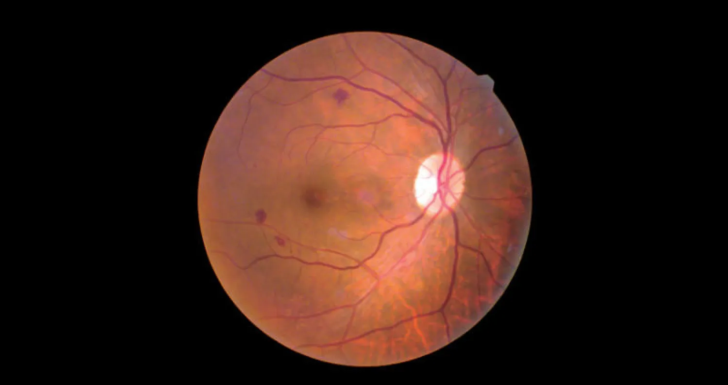 مركبات نباتية تمنع حدوث العمى لدى مرضى السكري