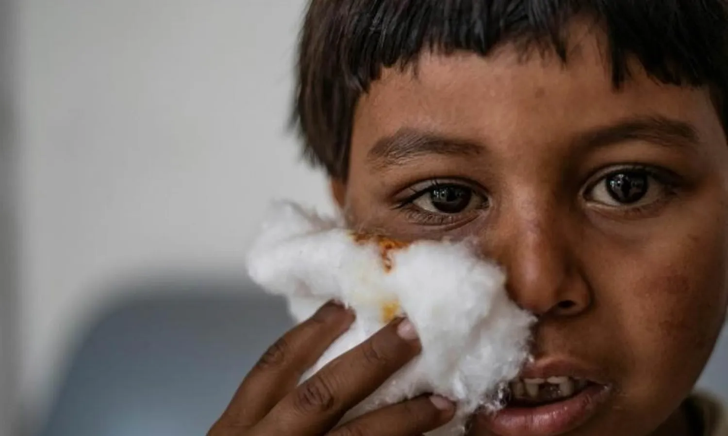 A Syrian boy holds a cotton wool over his cheek after receiving treatment for leishmaniasis skin disease at a health center in Karama northern Syria. (AFP)